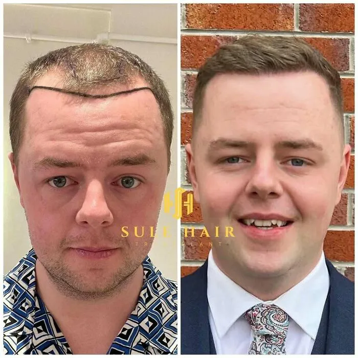 81 Hair Transplant Transformations That Completely Changed These People’s Looks