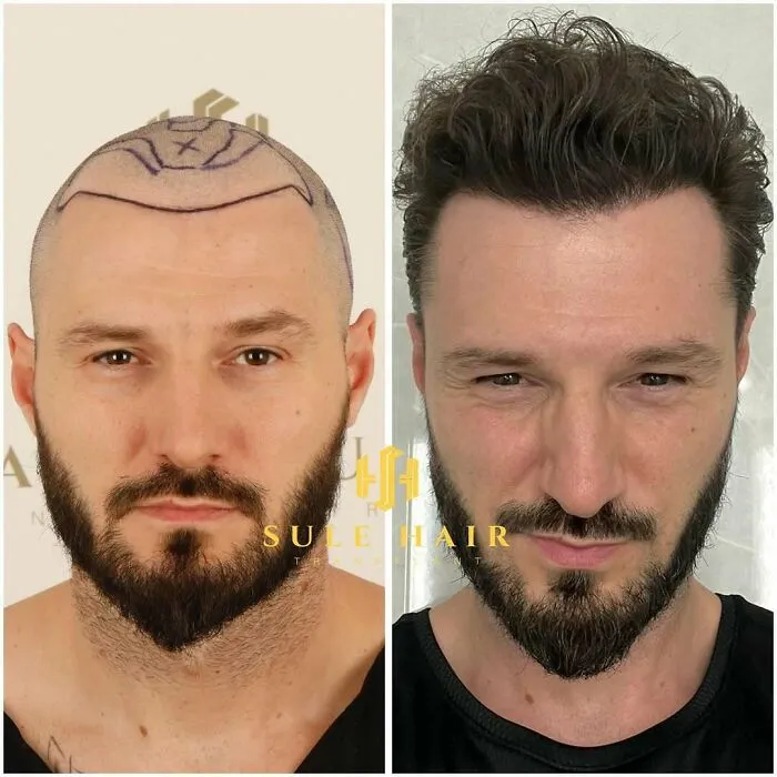 81 Hair Transplant Transformations That Completely Changed These People’s Looks