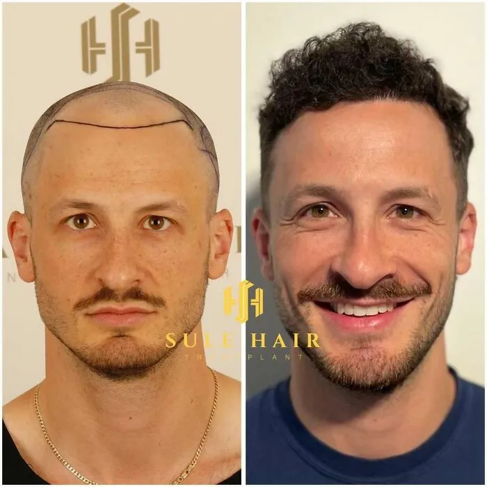 81 Hair Transplant Transformations That Completely Changed These People’s Looks