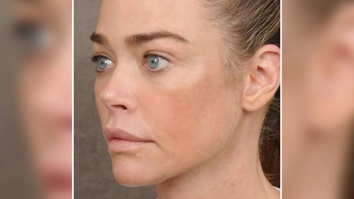 Denise Richards Reveal Before-And-After Look Following Wild Surgery