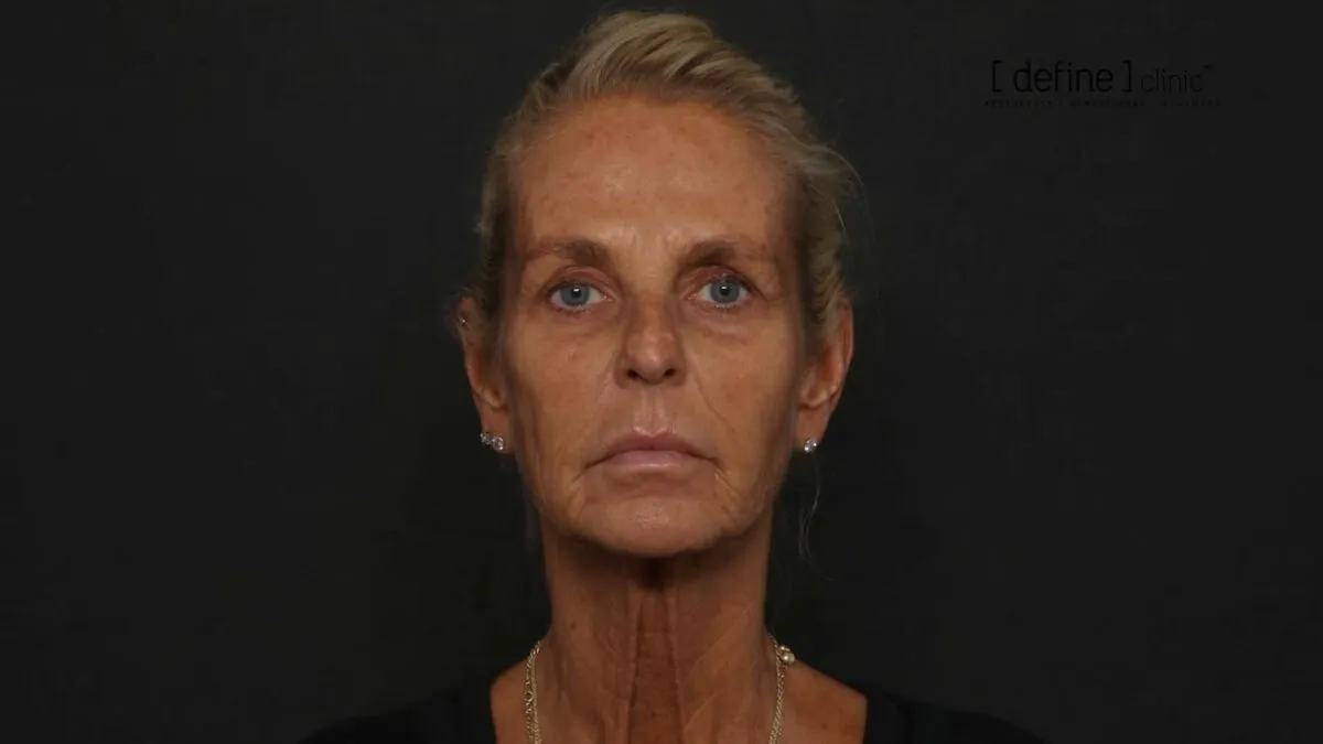 Ulrika Jonsson, 58, Reveals The Six Months Of Treatments Behind Her Dramatic Transformation