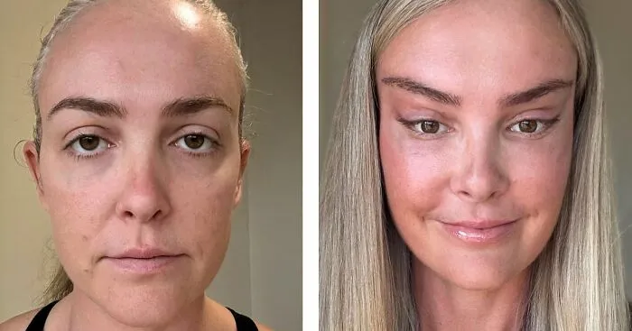 Esta mujer recibió burlas en internet tras mostrar el antes y el después de su cirugía estética