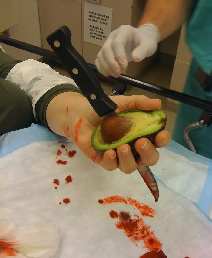 Close-up of a hand injury with a knife stuck in the palm, illustrating unusual medical photos between science and nightmare.