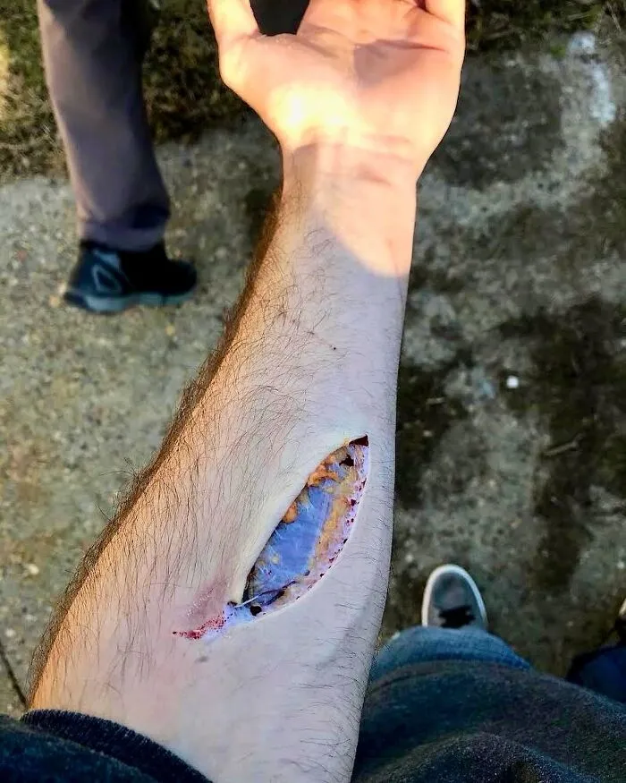 Close-up of an arm wound revealing unusual medical details, fitting between science and nightmare imagery.