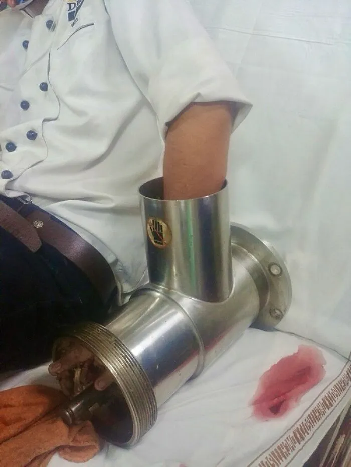 A Devastating Grinder Injury Of The Hand — Notice The Left Hand Caught Within The Meat Grinder!!