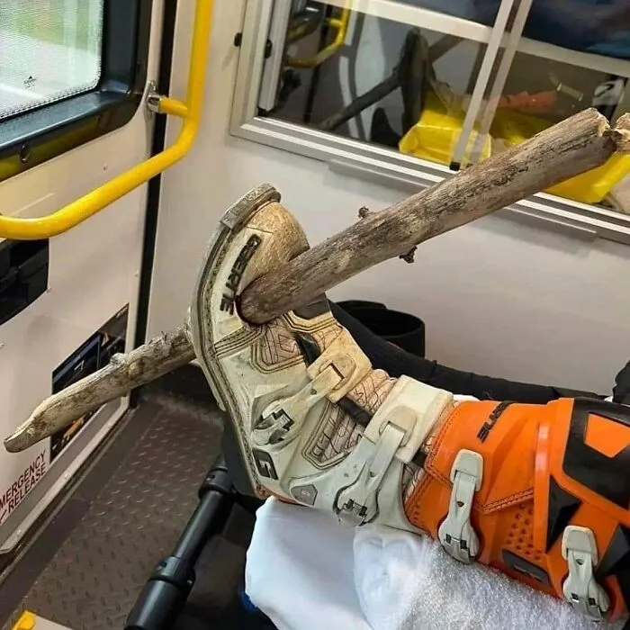 This Will Hurt In The Morning. Penetrating Branch Root Injury In A Motorcycle Enduro Rider!