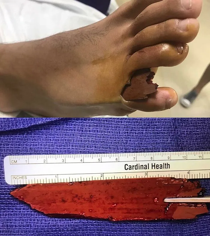 Close-up of a foot with a lodged medical foreign object and the extracted piece next to a ruler for scale.