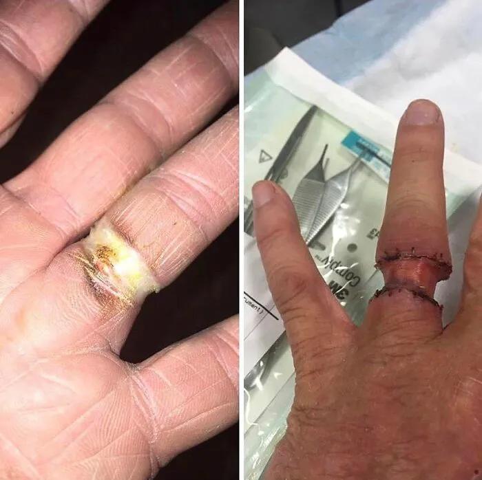 Close-up of a finger injury and surgical stitches showing unusual medical conditions in a clinical setting.