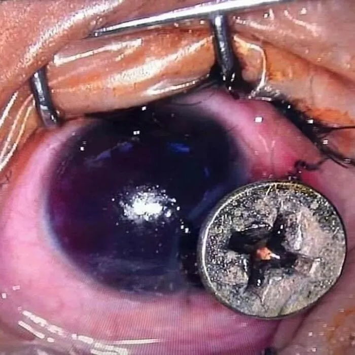 Close-up of an unusual medical photo showing a severely bruised eye with a foreign metallic object embedded.