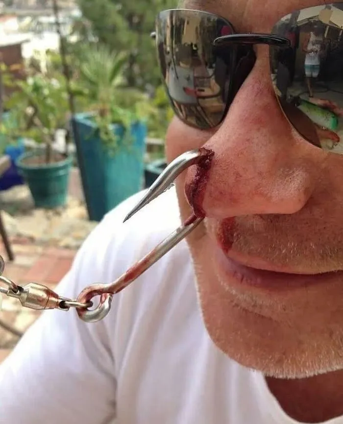 Man wearing sunglasses with a large metal hook piercing through his nose, an unusual medical photo depicting extreme body modification.