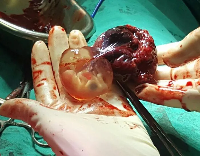Close-up of a gloved hand holding an unusual medical photo showing a fetus in amniotic sac during surgery.
