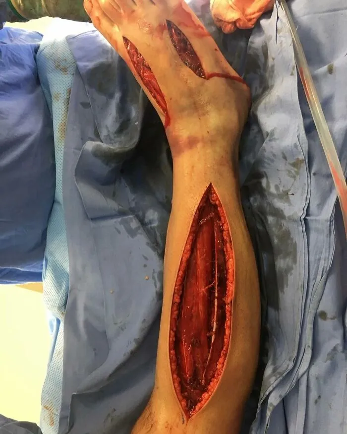 Close-up of a medical leg surgery showing deep open wounds and exposed muscle, illustrating unusual medical photos.