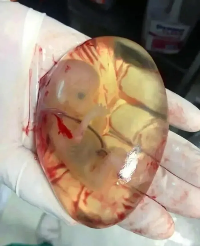Gloved hand holding a transparent amniotic sac with a visible human embryo inside in an unusual medical photo.