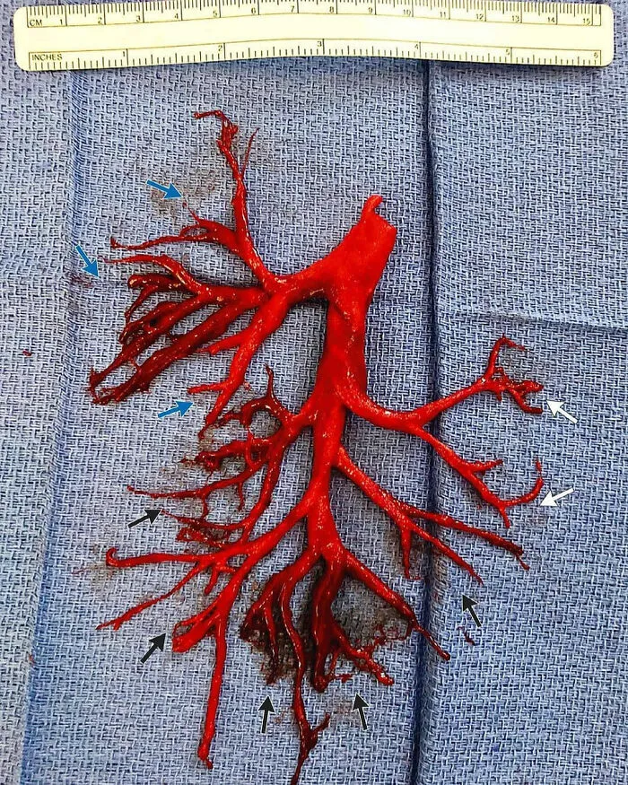 A Blood Clot Coughed Up By A Patient, That Perfectly Shaped The Lung’s Cavity It Filled