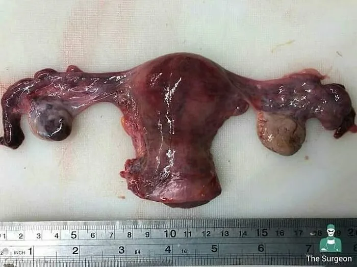 Close-up of an unusual medical specimen showing a human uterus with abnormalities, illustrating rare medical conditions.