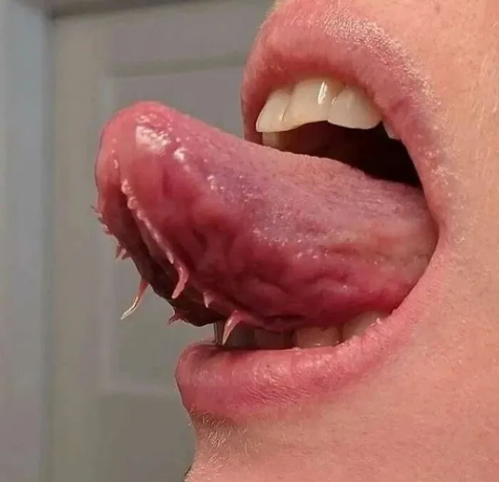 Close-up of a tongue with unusual growths and spikes, showcasing an unusual medical condition between science and nightmare.