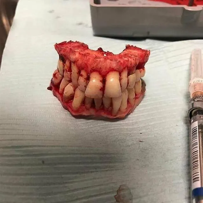 Severed human jaw with teeth covered in blood, displayed on a medical cloth next to a syringe in a clinical setting.