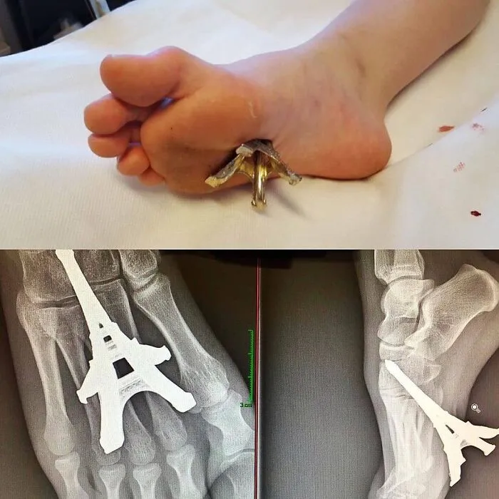 Foot with unusual foreign object resembling the Eiffel Tower impaled, shown in photo and X-ray in unusual medical photos.