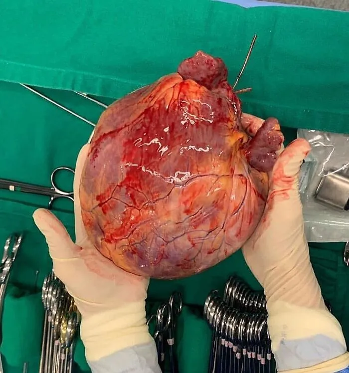 Large unusual medical photo showing a gloved surgeon holding a removed organ with surgical tools in the background.