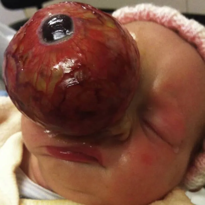 A Newborn With A Giant Teratoma Of The Right Orbit Saved By Embolisation And Surgery
