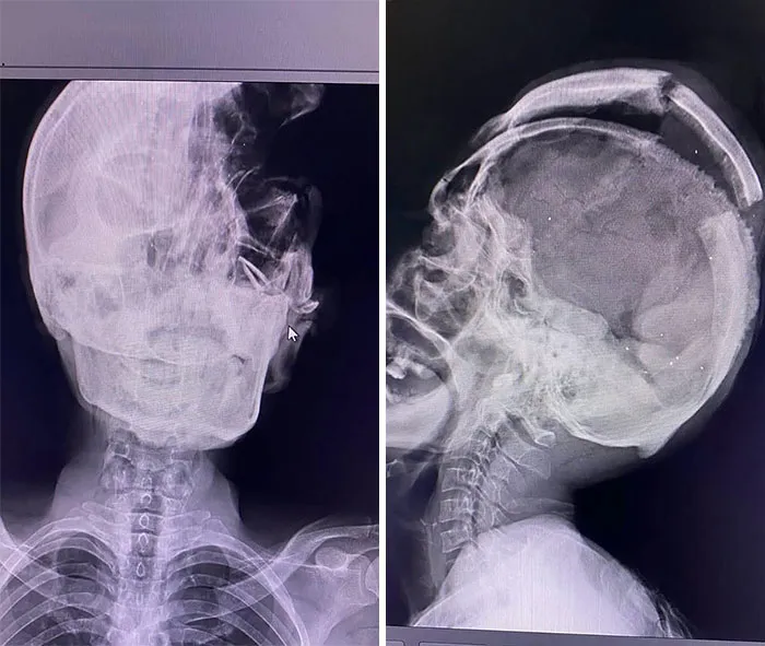 X-ray images showing unusual medical conditions affecting the skull and cervical spine in diagnostic medical photos.
