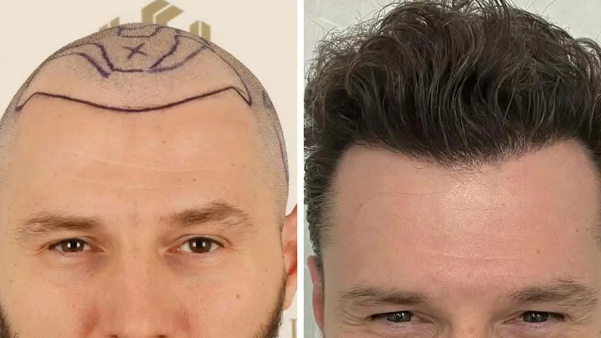 81 Hair Transplant Transformations That Completely Changed These People’s Looks