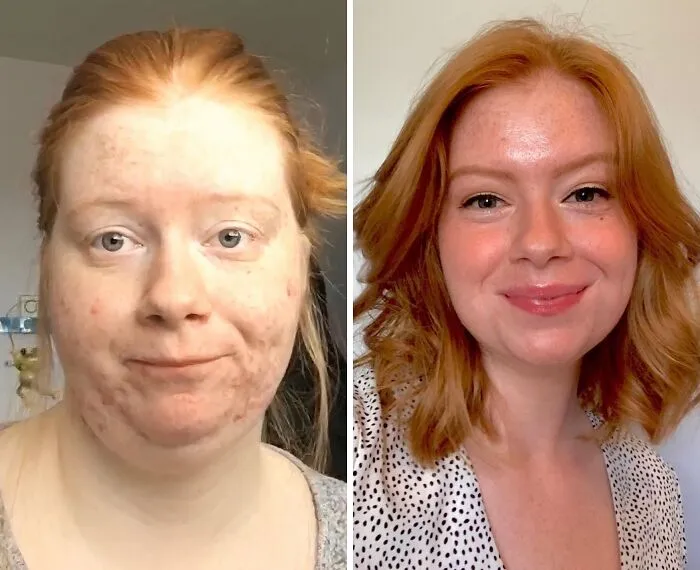 I Used To Be Afraid Of Having Short Hair Cause Of The Weight In My Face. Today, I Said Goodbye To The Old Me And Embraced My New Life