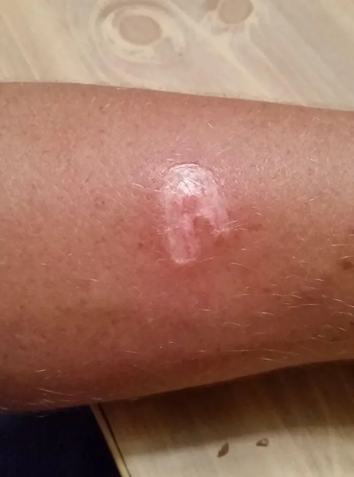 One Of My Drunk "Friends" Burnt Me With A Lighter Last Night