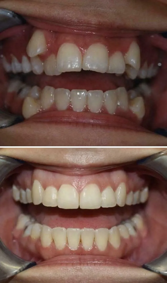 My Teeth, Before And After Braces