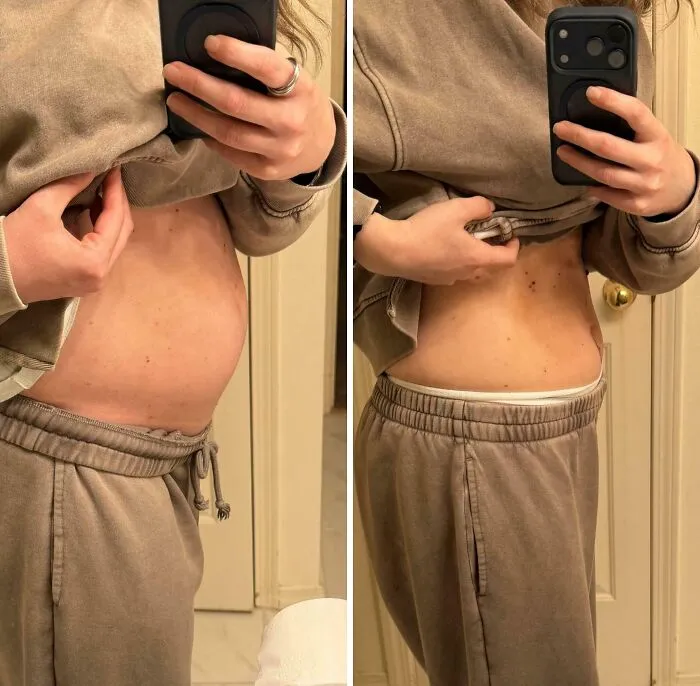 Before And After Of Ovarian Cyst Removal