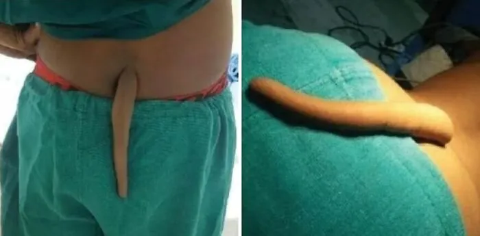 Vestigial Tailbone