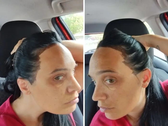 Me cobraron 140 dólares y me dijeron que era "imposible" quitarme el tinte del cuello, la frente y las orejas (sin siquiera intentarlo) y que se me quitaría "con el tiempo". Tengo un evento importante en unos días y esta noche estoy ocupada frotándome la cabeza hasta despellejarme.