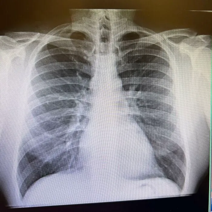 Asymmetric Lungs