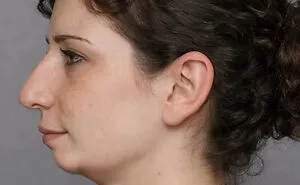 "Best Facial Harmonization I've Ever Seen": 25 Before-And-Afters By A Plastic Surgeon Whose Work Went Viral