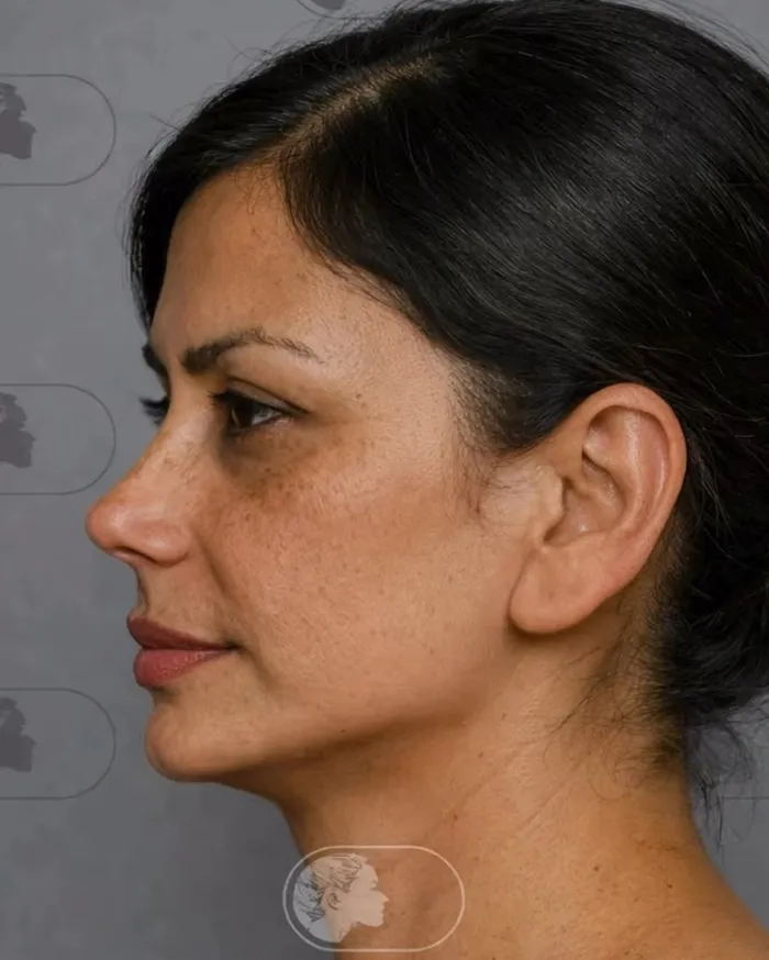 25 Personas que se ven irreconocibles tras su cirugía plástica