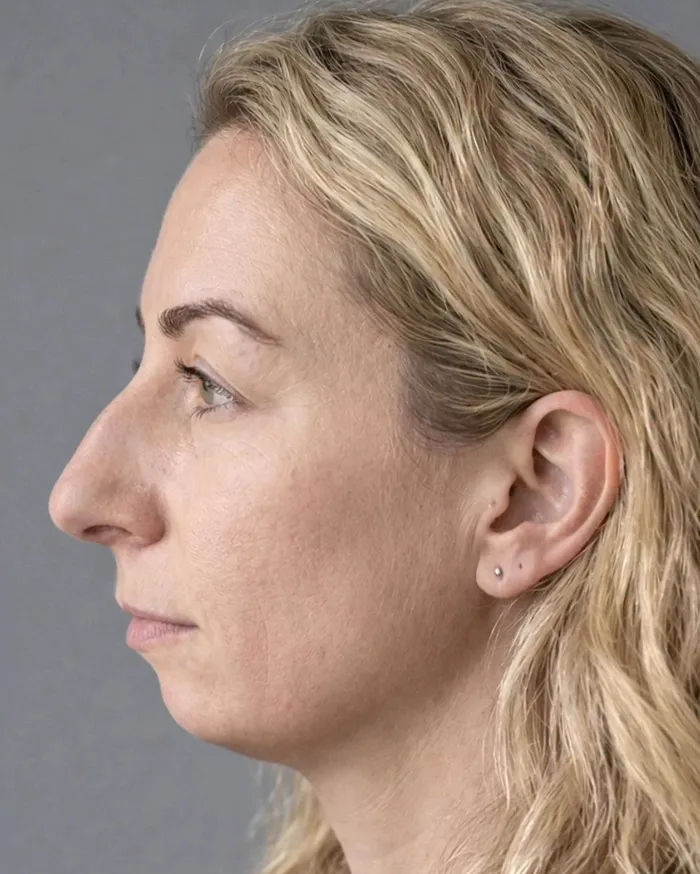 "Best Facial Harmonization I've Ever Seen": 25 Before-And-Afters By A Plastic Surgeon Whose Work Went Viral