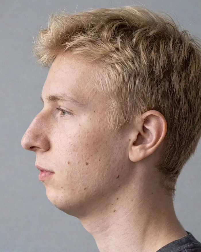 "Best Facial Harmonization I've Ever Seen": 25 Before-And-Afters By A Plastic Surgeon Whose Work Went Viral