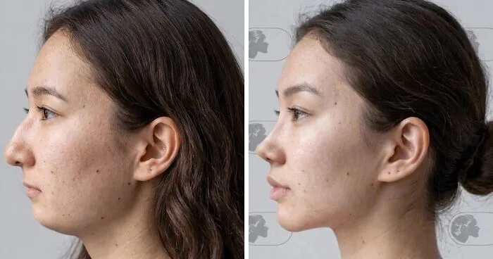 25 Personas que se ven irreconocibles tras su cirugía plástica