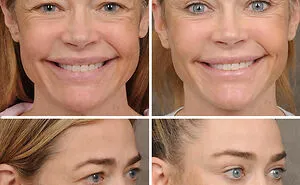 15 Times Celebrities And Influencers Shared Their Plastic Surgery Results Openly