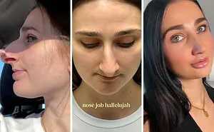 15 Times Celebrities And Influencers Shared Their Plastic Surgery Results Openly
