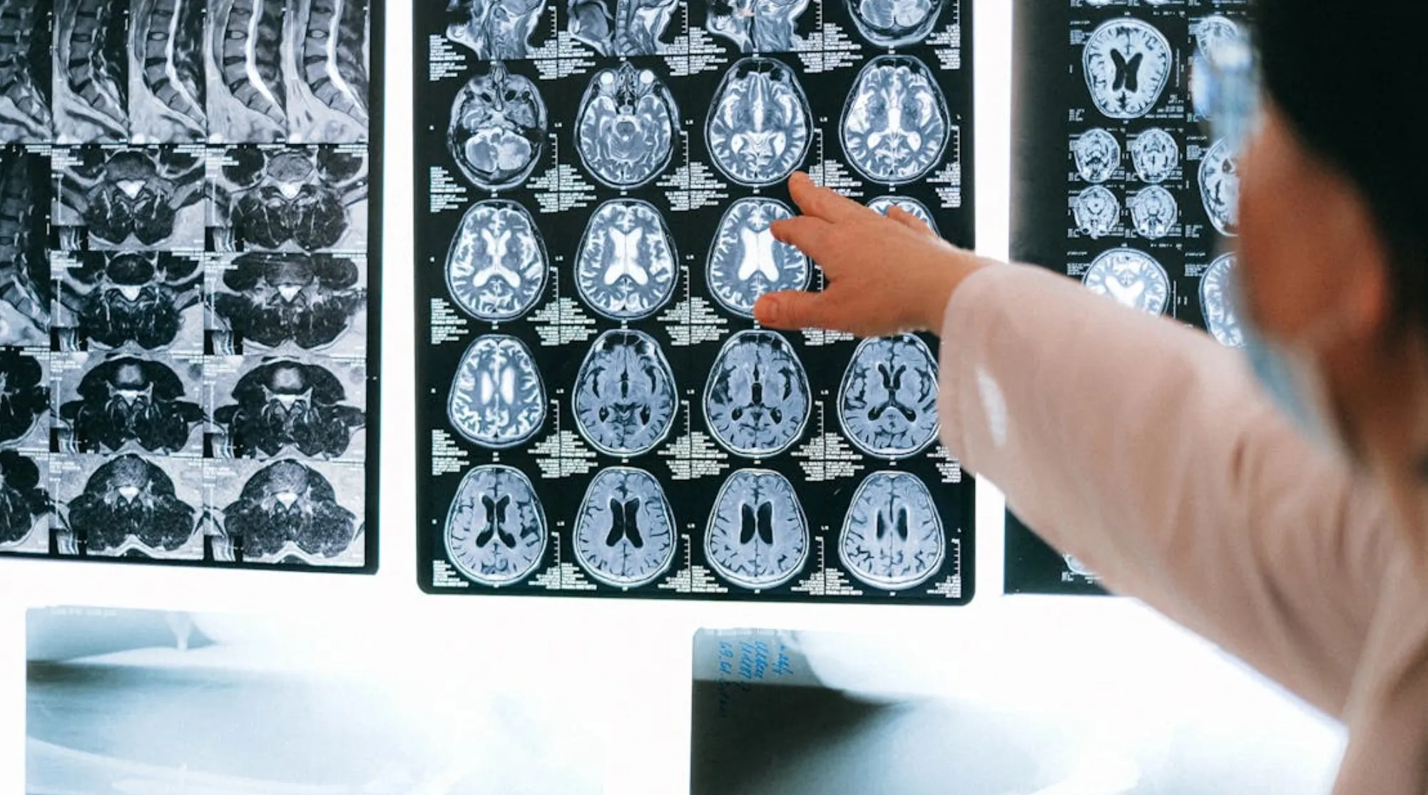 A doctor points to a brain scan, highlighting critical details. First Aid: Survival 101, stroke emergency.
