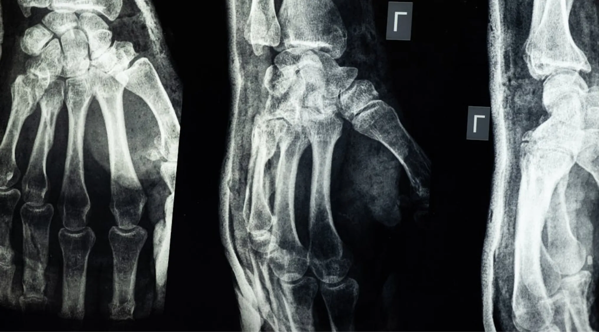 X-ray image of broken bones in a hand and wrist, showing the skeletal structure. Crucial for First Aid: Survival.
