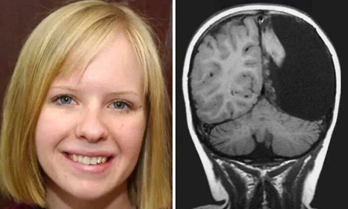 Christina Santhouse Had Half Her Brain Removed At Age 8 To Stop Constant Seizures