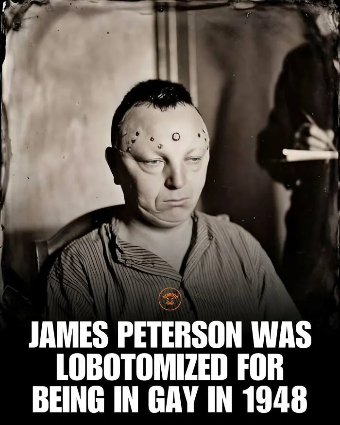 Black and white photo of lobotomized man with unusual marks on head, historical lobotomy fact