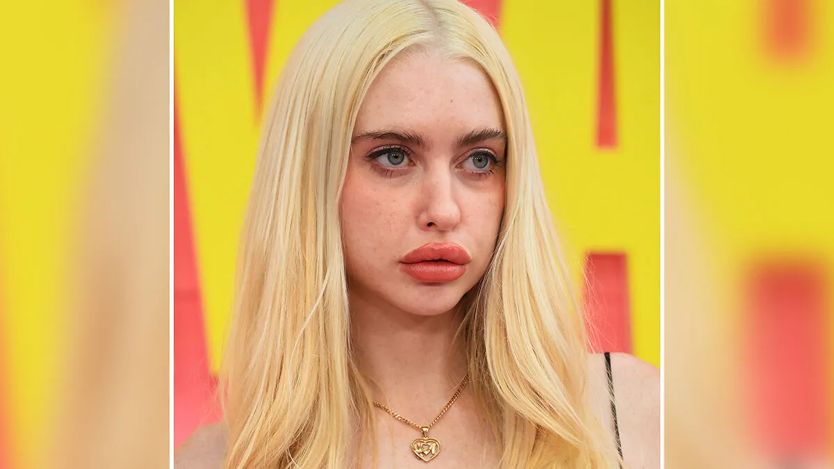 Chloe Cherry Sparks Frenzy After Revealing Disturbing Effect Of Repeated Lip Filler Procedures