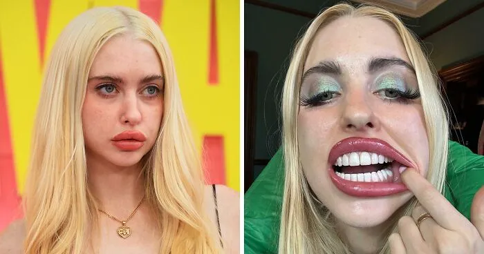 Chloe Cherry Sparks Frenzy After Revealing Disturbing Effect Of Repeated Lip Filler Procedures