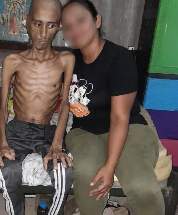 Extremely malnourished person sitting beside another individual in a distressing photo