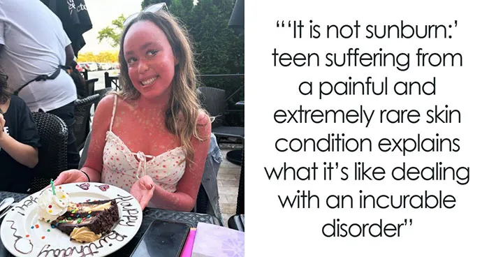 Teen Shows The Only Way She Can Control Her Rare Skin Condition, Shocks Doctors With Her Routine