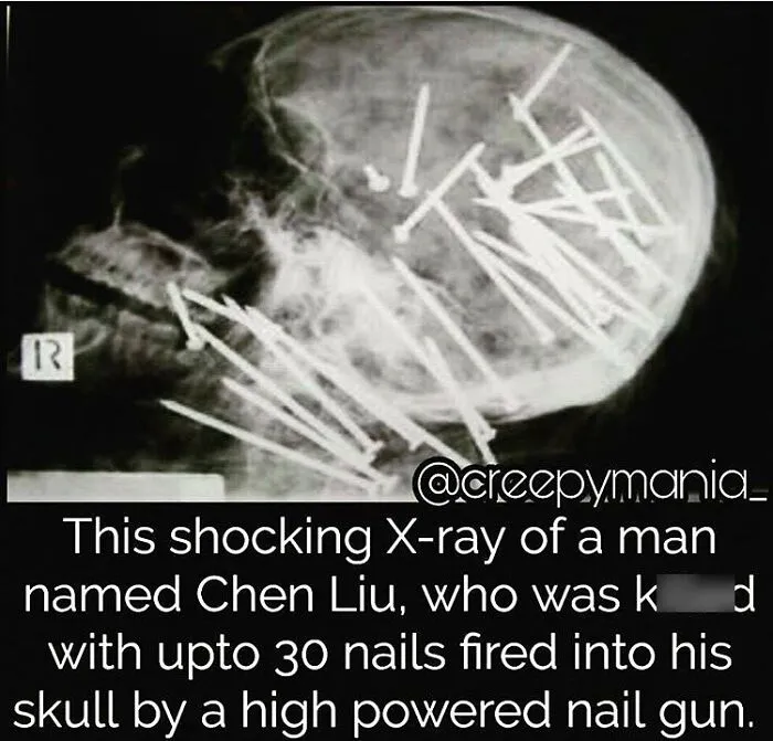 A shocking X-ray of a skull with nails, a terrifying fact and horror story example.