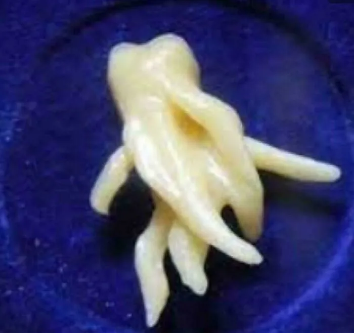 Someone’s Wisdom Tooth